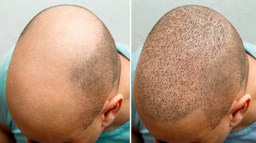 Quick Solution for Hair Loss: Tips and Safety Guide for Hair Transplantation